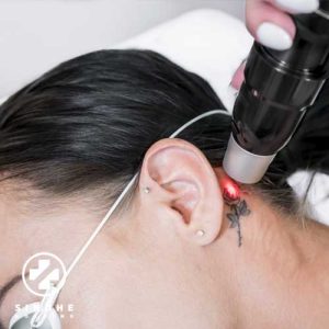 بهترین دستگاه‌های لیزر پاک‌کننده تاتو در ایران